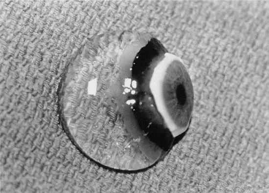 図1 硝子体の形状